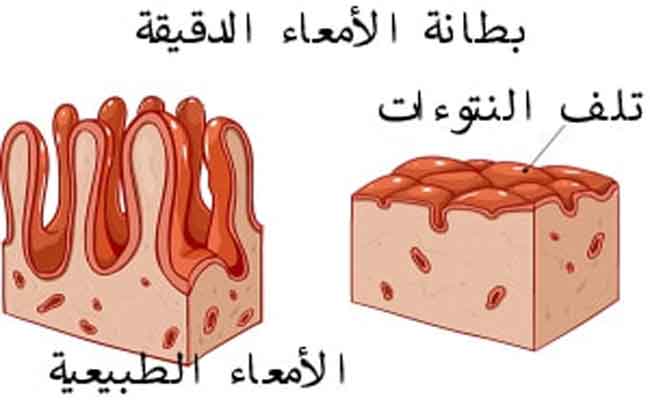 ما هو مرض السيلياك وأعراضه؟…وأفضل علاج
