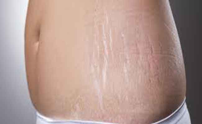 كيفية التخلص من علامات التمدد على الجلد بطرق طبيعية للنساء