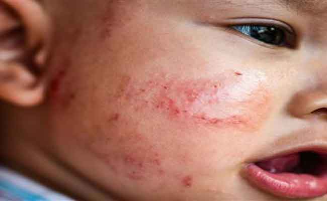 أعراض الحساسية الغذائية عند حديثي الولادة وكيفية التعامل معها