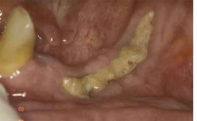 حالات تآكل الفك وطرق زراعة الأسنان جراحياً