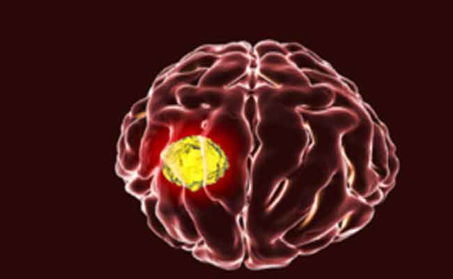 سرطان الدماغ: علاج جديد لأكثر الأنواع شراسة