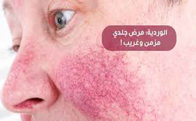 ما هو مرض الوردية؟ وما العلاجات المتاحة؟