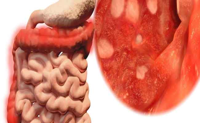 تجربتي مع التهاب القولون التقرحي تستحق القراءة…