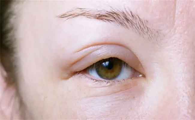 طرق فعالة لمحاربة إنتفاخ العينين في فصل الشتاء