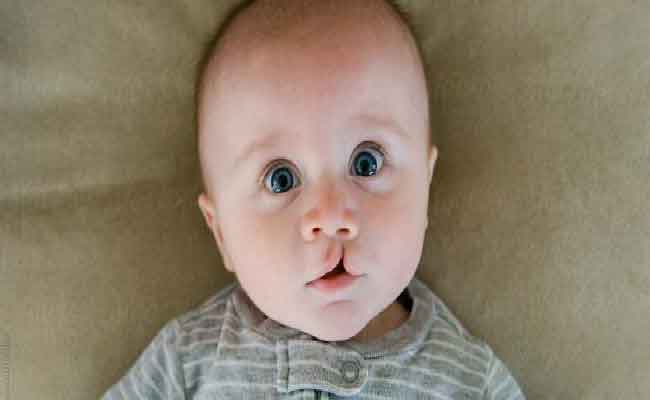 أسباب خلال الحمل تجعل طفلك معرضاً للإصابة بالشفة الأرنبية أو المشقوقة