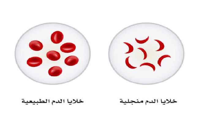 اليوم العالمي للأنيميا المنجلية: أعراض وأسباب المرض وطرق علاجه