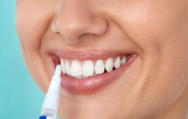 تبييض الأسنان الكيميائي يُعتبر آمناً وفق أطباء الأسنان