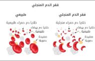 أعراض فقر الدم المنجلي وعلاجه