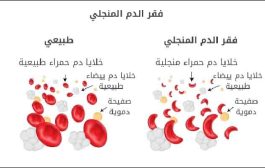 أعراض فقر الدم المنجلي وعلاجه