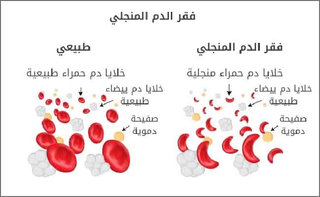 أعراض فقر الدم المنجلي وعلاجه
