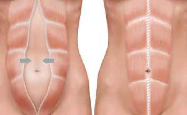 ما هو الانفصال العضلي للبطن وكيف يتم علاجه؟ طبيبة تُجيبكِ