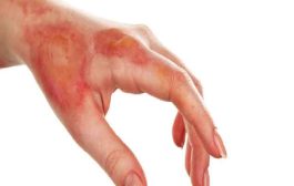 علاج حروق طفلك في المنزل...إسعافات أولية وأخطاء تجنبيها