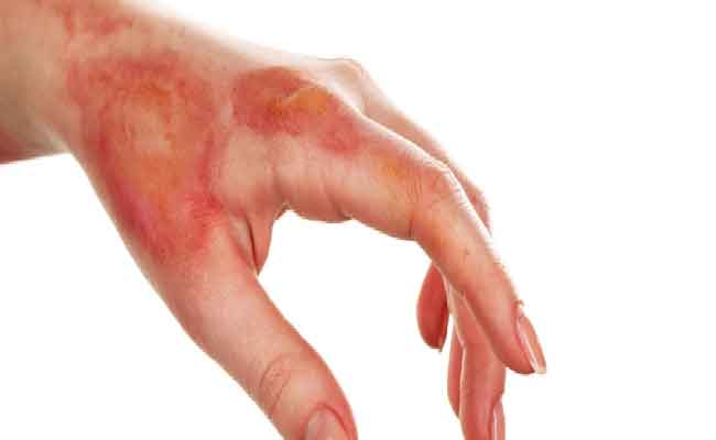 علاج حروق طفلك في المنزل...إسعافات أولية وأخطاء تجنبيها