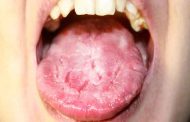 علاج فطريات اللسان في المنزل