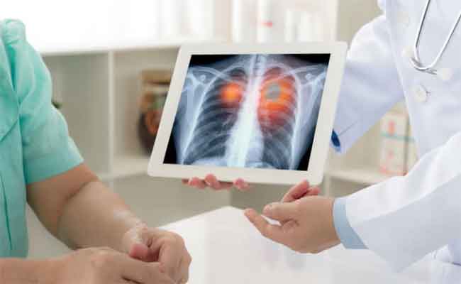 سرطان الرئة: النسب إلى ارتفاع بين النساء والسبب مع طبيب مختص