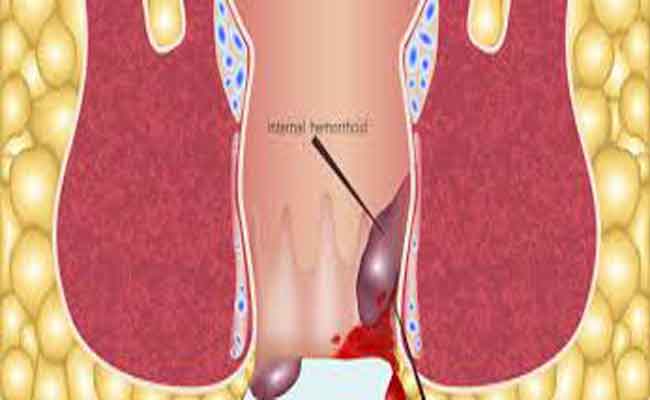 البواسير بعد الولادة…إليكِ أسبابها وكيفية علاج مضاعفاتها