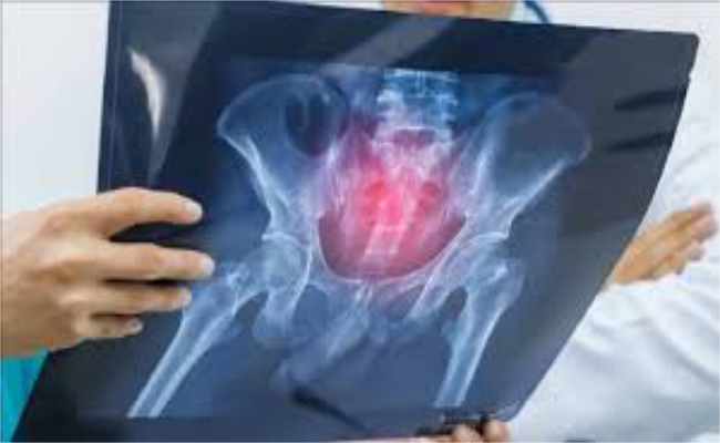 علامات خفية لهشاشة العظام لدى النساء…