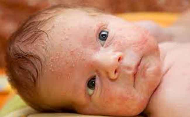 الحبوب في وجه الرضيع…متى تكون طبيعية ومتى تستدعي الطبيب؟