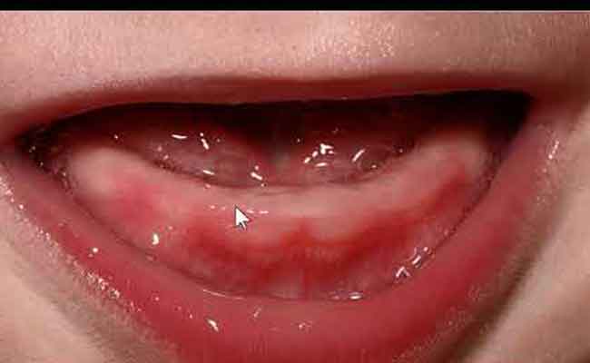 هل ظهور أسنان يسبب الإسهال والحرارة للطفل؟