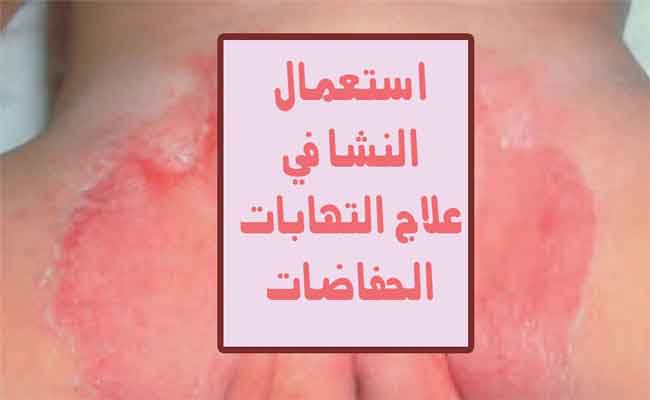 7 خطوات لمعالجة التسلخات الشديدة عند حديثي الولادة…