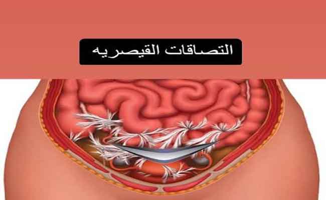 كيف يمكن تقليل التصاقات البطن بعد العملية القيصرية؟