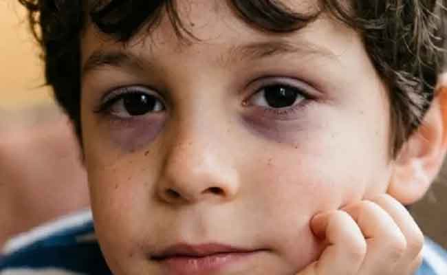 دليلك لفهم طبيعة الهالات السوداء لدى طفلك وطرق التعامل معها